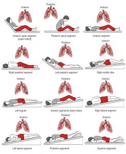 Postural Drainage - Saans Foundation